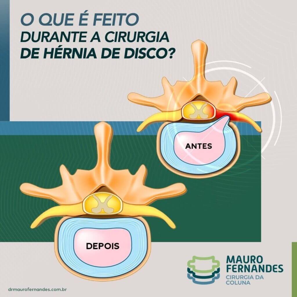 cirurgia de hérnia de disco